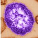Dupage county confirms measles case for vaccinated resident who traveled through o'hare airport 2026 - justice Dupage county confirms measles case for vaccinated resident who traveled through o'hare airport 2026