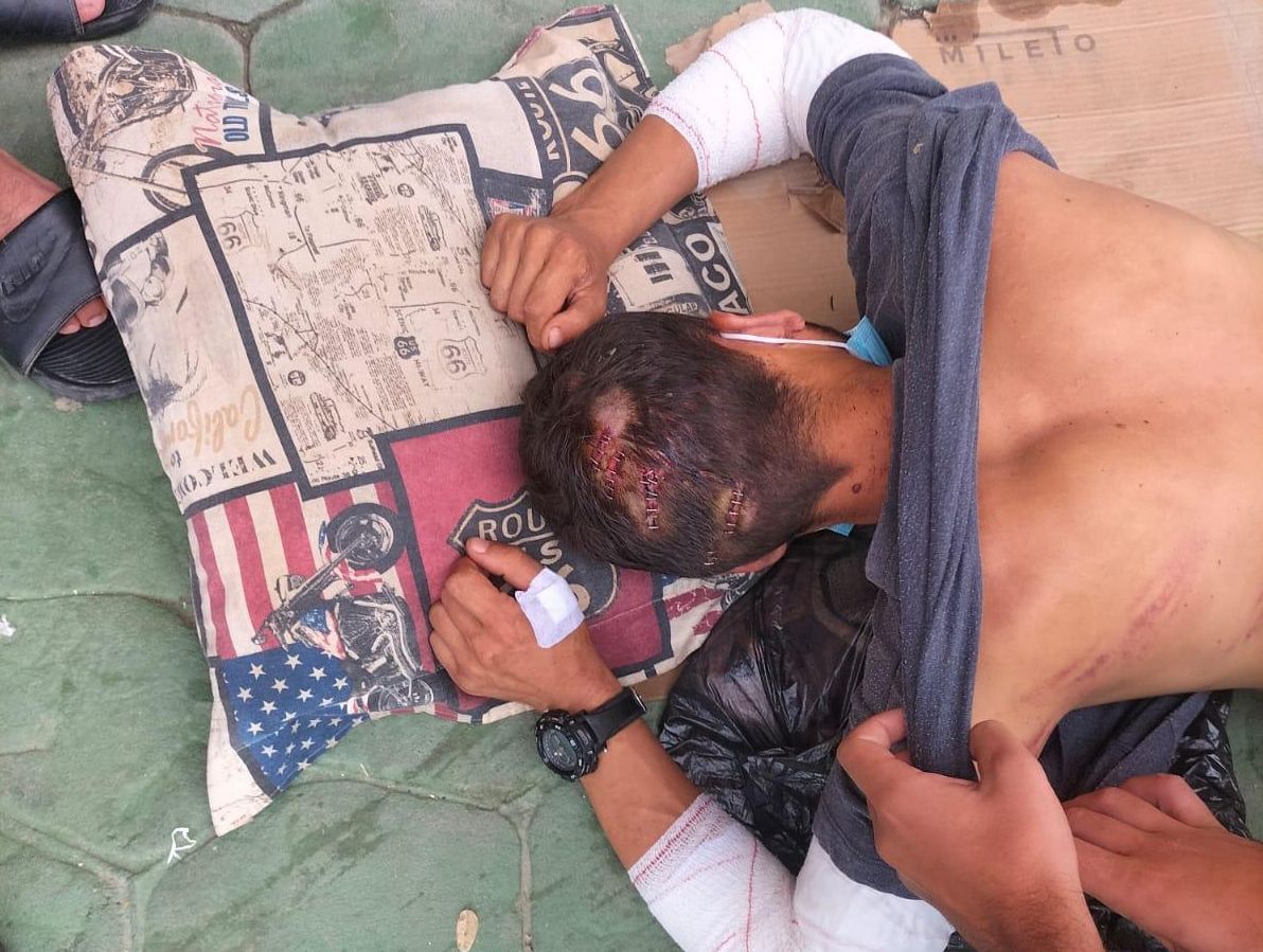 Una de las fotografías tomadas de las lesiones de mohamed tras ser atendido en el hospital, donde se ven las heridas con grapas de la cabeza, lesiones en los codos y marcas de porras en la espalda.
